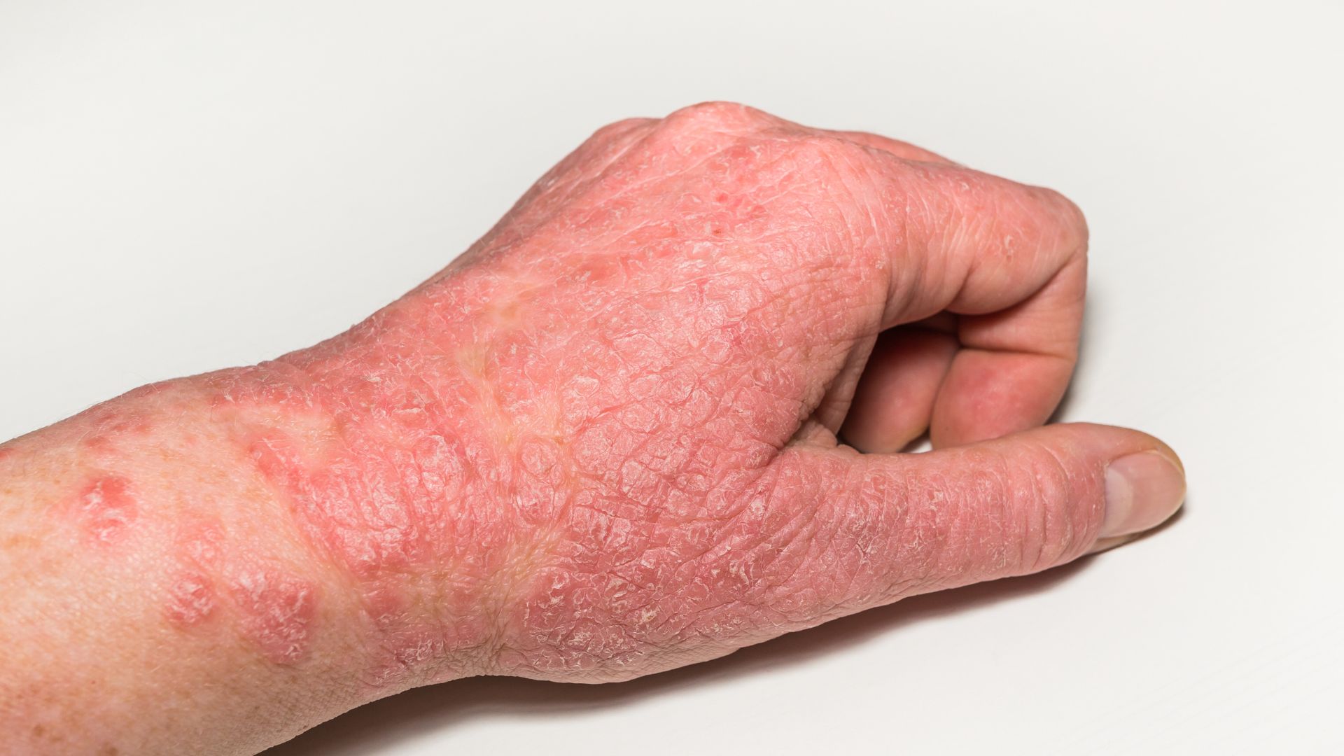 Psoriatrická artritída Príčiny vzniku, príznaky a možnosti liečbya